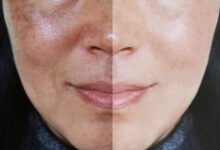 Which Treatments Are Best for Uneven Skin Texture? 11 Close-up comparison of uneven skin texture before and after treatment, showing smoother and more refined facial skin on the right side.