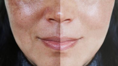 Which Treatments Are Best for Uneven Skin Texture? 6 Close-up comparison of uneven skin texture before and after treatment, showing smoother and more refined facial skin on the right side.