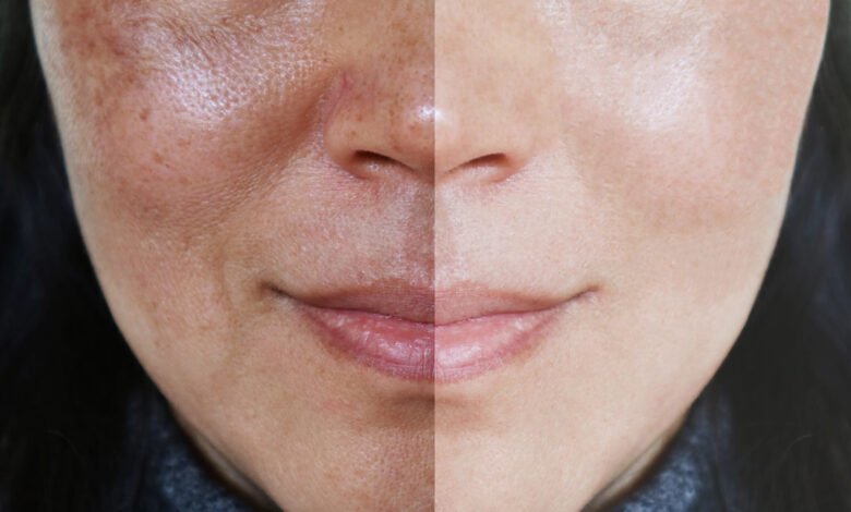 Close-up comparison of uneven skin texture before and after treatment, showing smoother and more refined facial skin on the right side.